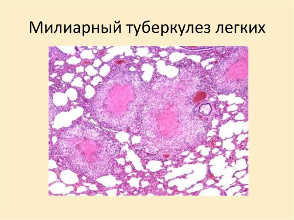 Милиарный туберкулез легкого микропрепарат