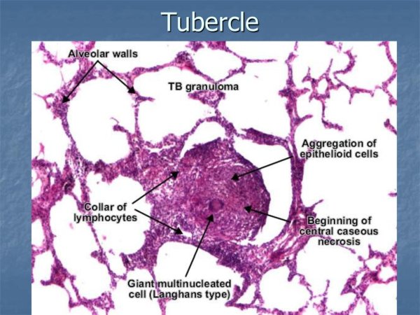 Туберкулезная гранулема в легких микропрепарат