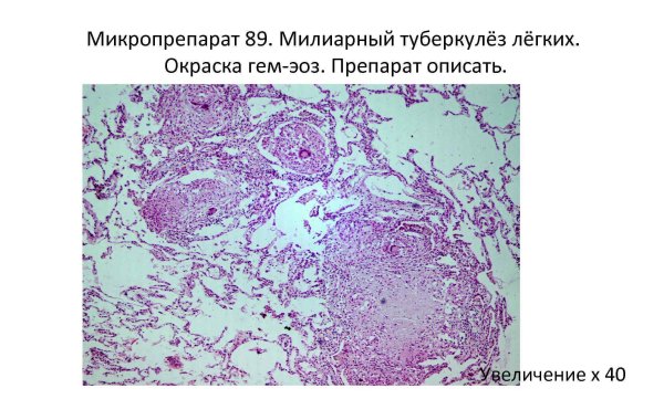 Милиарный туберкулёз лёгкого микропрепарат