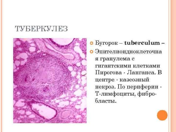 Туберкулезные бугорки в легком микропрепарат
