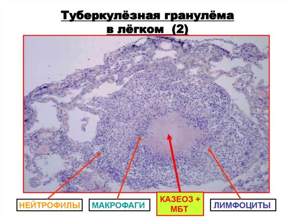 Туберкулёзная гранулёма патанатомия