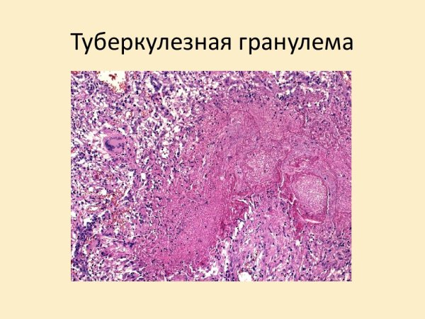 Туберкулезная гранулема казеозный некроз