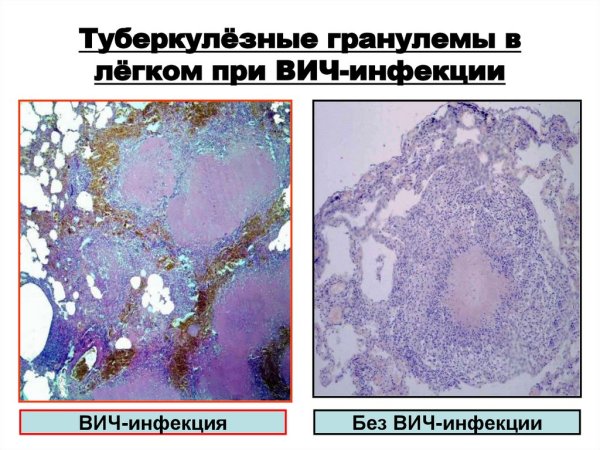 Патоморфология туберкулезной гранулемы