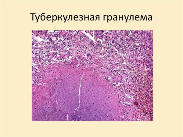 Фиброзно кавернозный микропрепарат