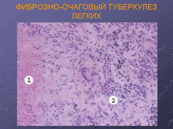 Инфекционные гранулемы микропрепарат