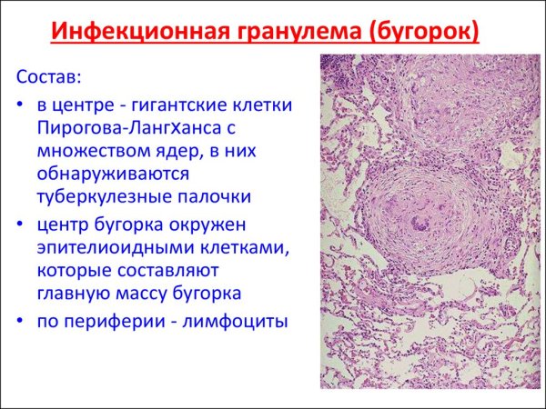Туберкулезная гранулема гистология