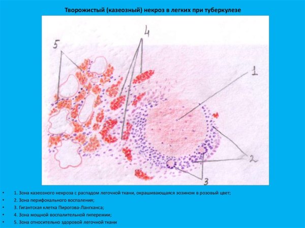 Туберкулезная гранулема в легких