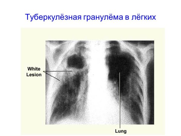 Локализация риносклеромной гранулемы