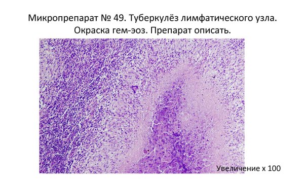 Патоморфология туберкулезной гранулемы