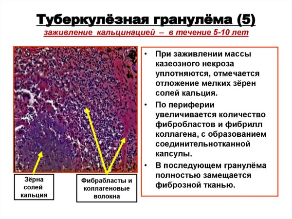 Милиарный туберкулез легкого микропрепарат