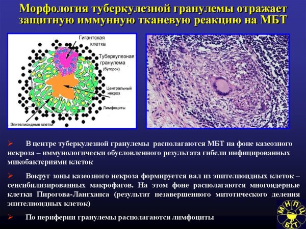 Туберкулезная гранулема в легком микропрепарат