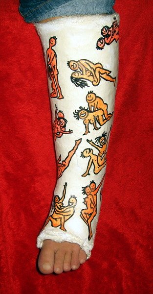 Разукрашенный гипс на руке