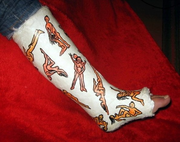 Разрисованный гипс на ноге