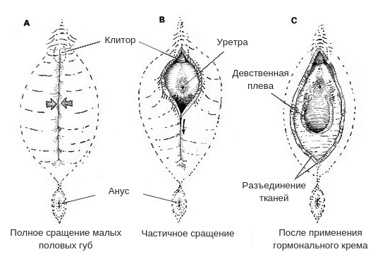 Девственная плева схема
