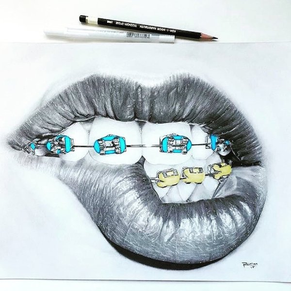 Картина зубы с брекетами