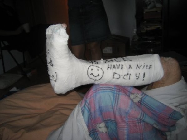 Креативный гипс на ноге