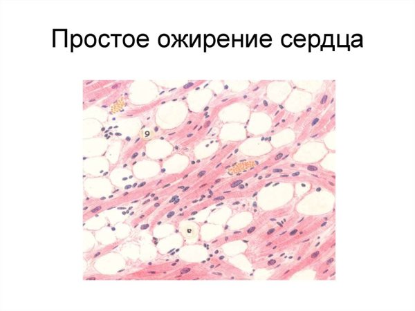 Гидропическая дистрофия сердца