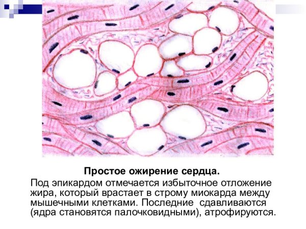 Ожирение миокарда макропрепарат