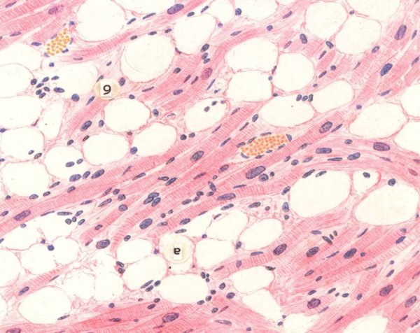 Ожирение сердца патологическая анатомия макропрепарат