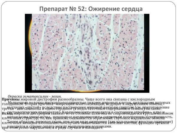 Ожирение сердца (окраска гематоксилином-эозином) патанатомия