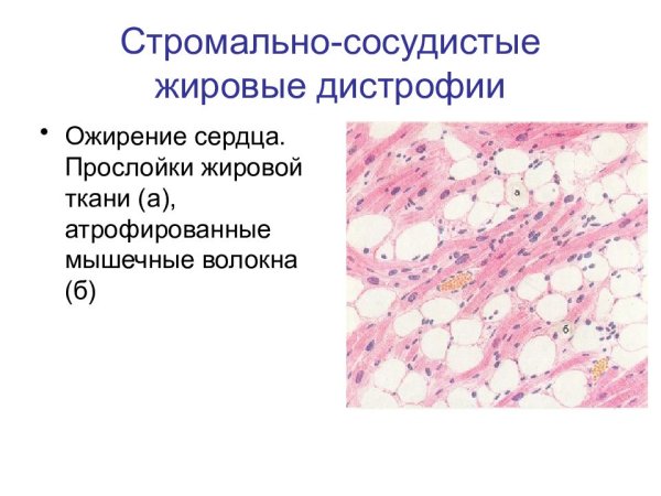 Жировые мезенхимальные дистрофии ожирение