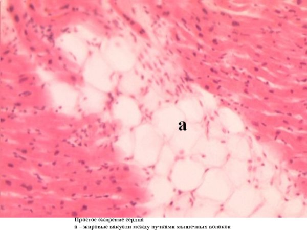 Ожирение сердца патанатомия