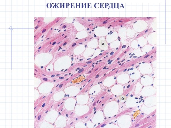 Клеточные жировые дистрофии