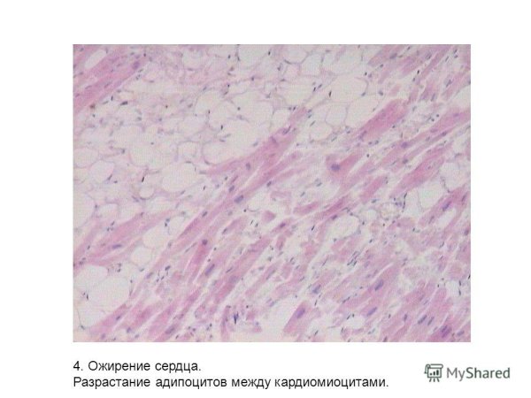 Ожирение сердца микропрепарат патанатомия