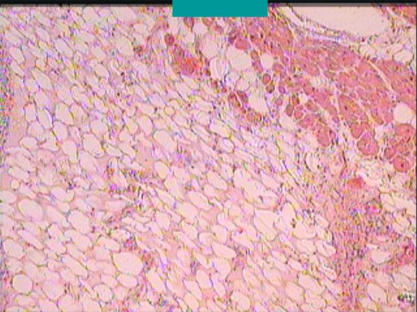 Ожирение (жировая дистрофия) миокарда