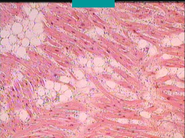 Жировая дистрофия миокарда гистология