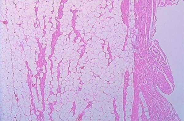 Ожирение сердца микропрепарат патологическая анатомия