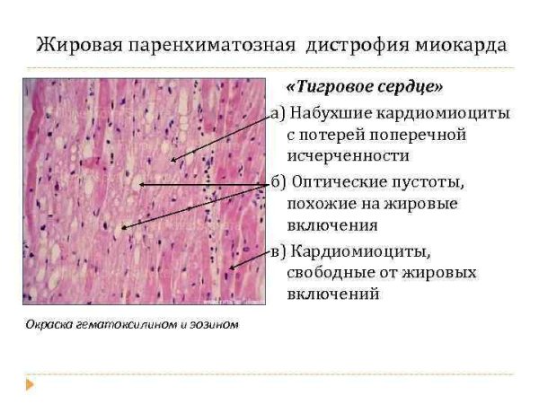 Паренхиматозная жировая дистрофия миокарда сердце