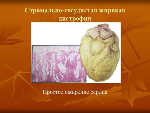 Ожирение миокарда патанатомия