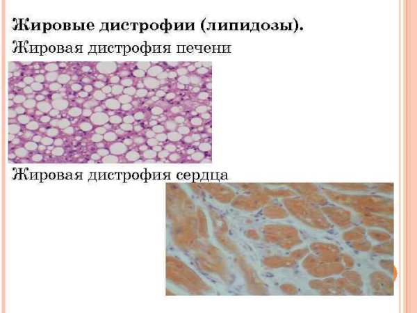 Жировые мезенхимальные дистрофии ожирение