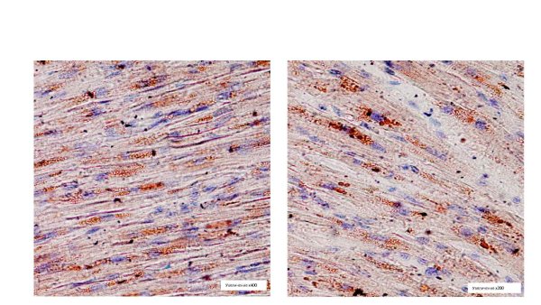 Жировая дистрофия миокарда микропрепарат Судан 3