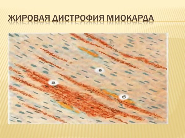 Жировая дистрофия миокарда окраска Суданом