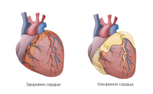 Ожирение сердца симптомы