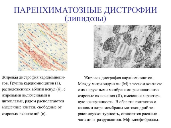 Гипертрофия миокарда препарат патологическая анатомия