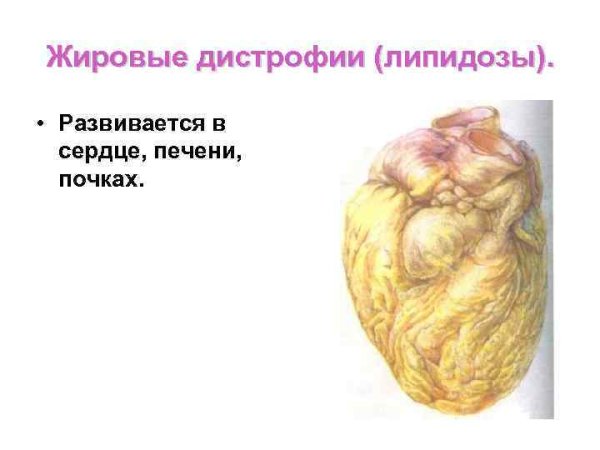 Жировая дистрофия печени микропрепарат