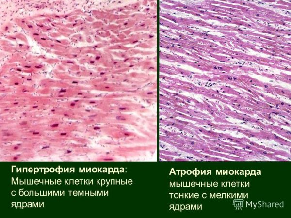 Осложнения ожирения у мужчин