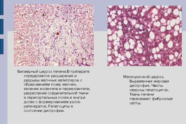 Сердце здорового человека и с ожирением