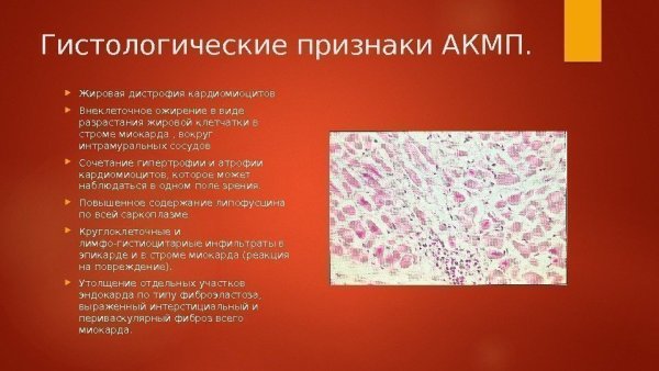 Жировое Перерождение сердца