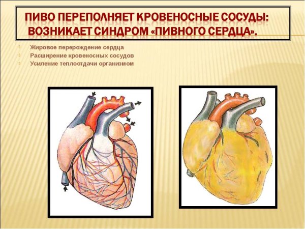 Жировая дистрофия кардиомиоцитов