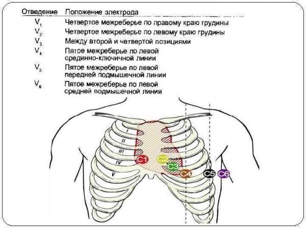 Схема наложения грудных электродов ЭКГ