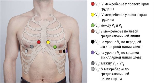 Наложение грудных электродов ЭКГ