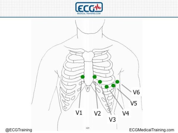 Схема наложения электродов при снятии ЭКГ