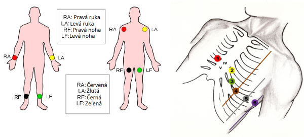 Электроды ЭКГ схема наложения