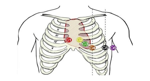 Отведения ЭКГ наложение электродов
