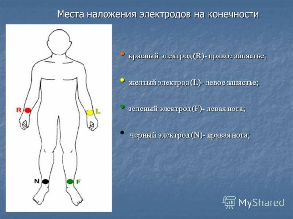 ЭКГ последовательность наложения электродов
