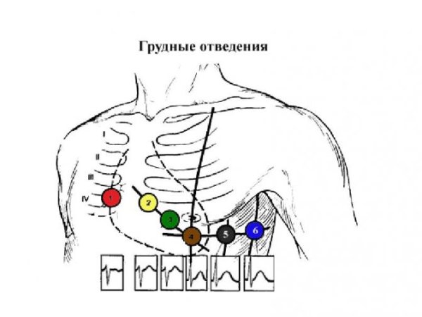 Наложение грудных электродов ЭКГ